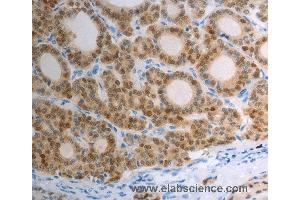 Immunohistochemistry of Human thyroid cancer using S100A1 Polyclonal Antibody at dilution of 1:40 (S100A1 antibody)