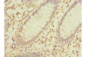 Immunohistochemistry of paraffin-embedded human colon cancer using ABIN7142357 at dilution of 1:100 (MRPL16 antibody  (AA 37-251))