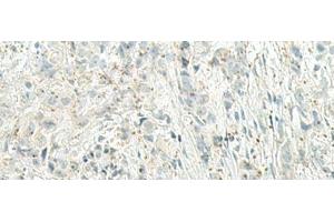 Immunohistochemistry of paraffin-embedded Human breast cancer tissue using UQCC2 Polyclonal Antibody at dilution of 1:60(x200) (MNF1 antibody)