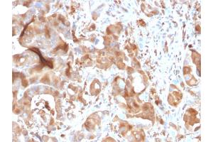 Formalin-fixed, paraffin-embedded human Hepatic Carcinoma stained with FABP5 Mouse Monoclonal Antibody (CPTC-FABP5-3). (FABP5 antibody)