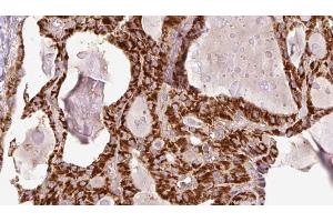 ABIN6267207 at 1/100 staining Human thyroid cancer tissue by IHC-P. (WIPI2 antibody  (pSer413))