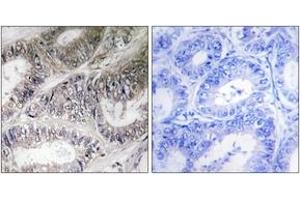 Immunohistochemistry analysis of paraffin-embedded human colon carcinoma tissue, using COX19 Antibody. (COX19 antibody  (AA 10-59))