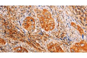 Immunohistochemistry of paraffin-embedded Human cervical cancer using SLC25A4 Polyclonal Antibody at dilution of 1:40 (SLC25A4 antibody)