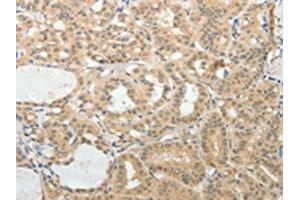 The image on the left is immunohistochemistry of paraffin-embedded Human thyroid cancer tissue using ABIN7189710(AFF2 Antibody) at dilution 1/25, on the right is treated with synthetic peptide. (AFF2 antibody)