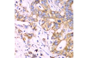 Immunohistochemistry of paraffin-embedded human liver cancer using RPS3A Antibody. (RPS3A antibody)