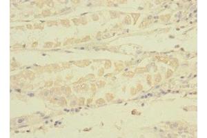 Immunohistochemistry of paraffin-embedded human gastric cancer using  at dilution of 1:100 (TNRC6A antibody  (AA 1-161))