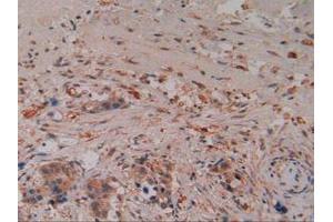 IHC-P analysis of Human Pancreas Cancer Tissue, with DAB staining. (Caspase 8 antibody  (AA 7-216))