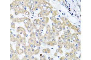 Immunohistochemistry of paraffin-embedded Human liver damage using RAB24 Polyclonal Antibody at dilution of 1:100 (40x lens). (RAB24 antibody)
