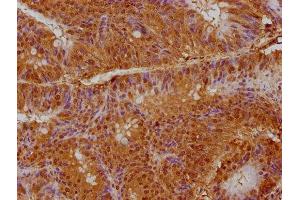 IHC image of ABIN7163013 diluted at 1:200 and staining in paraffin-embedded human colon cancer performed on a Leica BondTM system. (PPARG antibody  (AA 1-477))