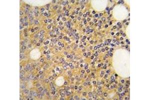 IHC analysis of FFPE human prostate carcinoma tissue stained with PRMT3 antibody (PRMT3 antibody  (AA 460-491))