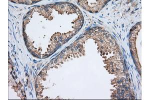 Immunohistochemical staining of paraffin-embedded Adenocarcinoma of Human ovary tissue using anti-TTC32 mouse monoclonal antibody. (TTC32 antibody)