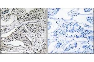 Immunohistochemistry analysis of paraffin-embedded human breast carcinoma tissue, using PLD3 Antibody.