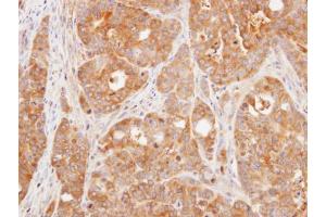 IHC-P Image Immunohistochemical analysis of paraffin-embedded N87 xenograft, using DUSP3, antibody at 1:500 dilution. (Dual Specificity Phosphatase 3 (DUSP3) antibody)
