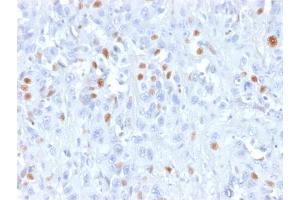 Formalin-fixed, paraffin-embedded human Urothelial carcinoma stained with p21 Mouse Recombinant Monoclonal Antibody (rCIP1/823). (Recombinant p21 antibody)