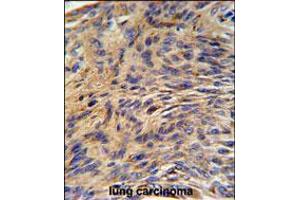 HSPA5 Antibody IHC analysis in formalin fixed and paraffin embedded human lung carcinoma followed by peroxidase conjugation of the secondary antibody and DAB staining. (GRP78 antibody  (AA 261-289))