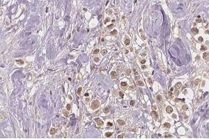 ABIN6267274 at 1/100 staining human breast carcinoma tissue sections by IHC-P. (Estrogen Receptor alpha antibody  (pSer167))