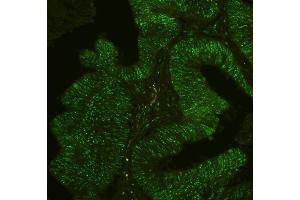 IF analysis of PHF21A using anti-PHF21A antibody (ABIN6719353) PHF21A was detected in paraffin-embedded section of human intestinal cancer tissues. (PHF21A antibody  (AA 1-97))