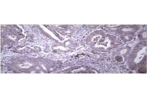 Immunohistochemical staining of paraffin embedded colon carcinoma using MMP9 antibody . (MMP 9 antibody  (C-Term))