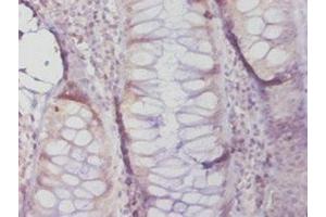 Immunohistochemistry of paraffin-embedded human colon cancer using ABIN7159622 at dilution of 1:20 (MGMT antibody  (AA 4-207))