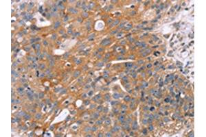 The image on the left is immunohistochemistry of paraffin-embedded Human breast cancer tissue using ABIN7130502(OPTN Antibody) at dilution 1/25, on the right is treated with fusion protein. (OPTN antibody)