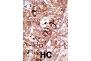 Formalin-fixed and paraffin-embedded human cancer tissue reacted with the primary antibody, which was peroxidase-conjugated to the secondary antibody, followed by AEC staining. (BAD antibody  (AA 92-127))