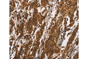 Immunohistochemical analysis of paraffin-embedded Human gastric cancer tissue using at dilution 1/25. (CTAG1A antibody  (Internal Region))
