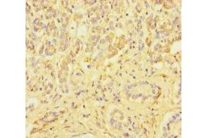 Immunohistochemistry of paraffin-embedded human pancreatic cancer using ABIN7176008 at dilution of 1:100 (ZSCAN29 antibody  (AA 1-300))