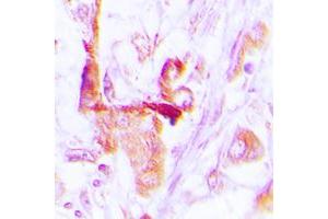 Immunohistochemical analysis of EEF2 staining in human lung cancer formalin fixed paraffin embedded tissue section. (EEF2 antibody  (N-Term))
