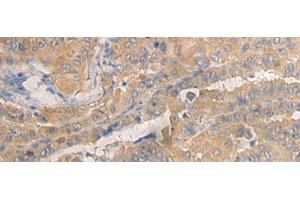 Immunohistochemistry of paraffin-embedded Human thyroid cancer tissue using AGAP3 Polyclonal Antibody at dilution of 1:25(x200) (AGAP3 antibody)