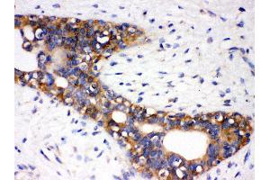 Anti- AGTR1 Picoband antibody, IHC(P) IHC(P): Human Mammary Cancer Tissue (Angiotensin II Type-1 Receptor antibody  (N-Term))