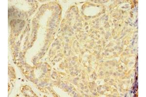 Immunohistochemistry of paraffin-embedded human breast cancer using ABIN7166213 at dilution of 1:100 (SEC31A antibody  (AA 335-503))