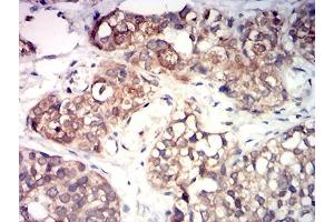 Immunohistochemical analysis of paraffin-embedded bladder cancer tissues using KMT5A mouse mAb with DAB staining. (SETD8 antibody  (AA 109-272))