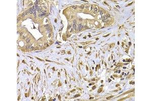 Immunohistochemistry of paraffin-embedded Human liver cancer using FSCN1 Polyclonal Antibody at dilution of 1:100 (40x lens). (Fascin antibody)
