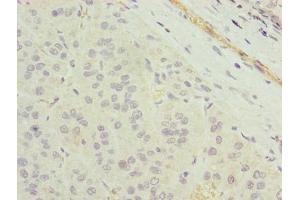 Immunohistochemistry of paraffin-embedded human liver cancer using ABIN7173103 at dilution of 1:100 (TMEM177 antibody  (AA 219-311))