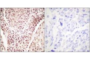 Immunohistochemistry analysis of paraffin-embedded human breast carcinoma, using Chk2 (Phospho-Thr387) Antibody. (CHEK2 antibody  (pThr387))
