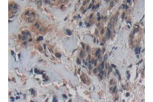 Detection of Cys-C in Human Breast cancer Tissue using Polyclonal Antibody to Cystatin C (Cys-C) (Cystathionine-gamma-Synthase Precursor (CYS) (AA 27-146) antibody)