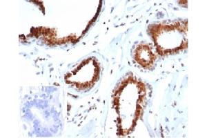 Formalin-fixed, paraffin-embedded human breast carcinoma stained with p27 Recombinant Mouse Monoclonal Antibody (rKIP1/1356). (Recombinant CDKN1B antibody)