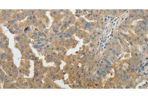 Immunohistochemistry of paraffin-embedded Human ovarian cancer tissue using SYT6 Polyclonal Antibody at dilution 1:40