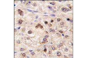 Formalin-fixed and paraffin-embedded human hepatocarcinoma tissue reacted with ZBTB7B antibody (Center), which was peroxidase-conjugated to the secondary antibody, followed by DAB staining. (ZBTB7B antibody  (Middle Region))