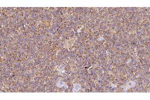 ABIN6273196 at 1/100 staining Human lymph cancer tissue by IHC-P. (ASRGL1 antibody  (Internal Region))