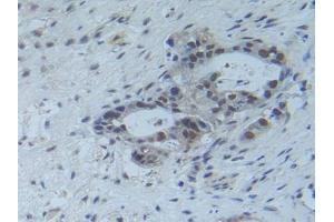 Detection of Raftlin in Human Pancreas Cancer Tissue using Polyclonal Antibody to Raft Linking Protein (Raftlin) (RFTN1 antibody  (AA 288-520))