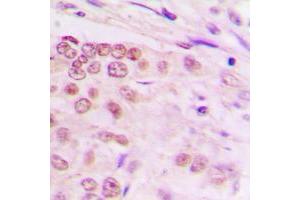 Immunohistochemical analysis of ALX3 staining in human lung cancer formalin fixed paraffin embedded tissue section. (ALX3 antibody  (Center))