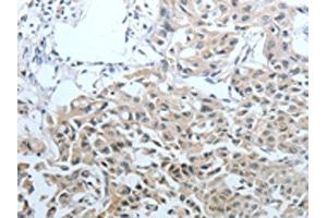 The image on the left is immunohistochemistry of paraffin-embedded Human lung cancer tissue using ABIN7128892(CEACAM1 Antibody) at dilution 1/25, on the right is treated with fusion protein. (CEACAM1 antibody)