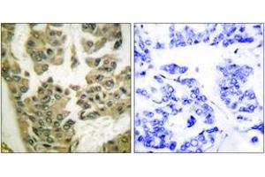Immunohistochemistry analysis of paraffin-embedded human breast carcinoma, using GRF-1 (Phospho-Tyr1105) Antibody. (GRLF1 antibody  (pTyr1105))