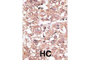 Formalin-fixed and paraffin-embedded human hepatocellular carcinoma tissue reacted with TLR7 polyclonal antibody  , which was peroxidase-conjugated to the secondary antibody, followed by AEC staining. (TLR7 antibody  (N-Term))