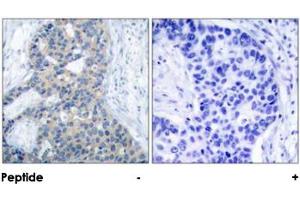 Immunohistochemical analysis of paraffin-embedded human breast carcinoma tissue using STMN1 (phospho S37) polyclonal antibody . (Stathmin 1 antibody  (pSer37))