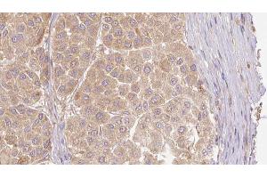 ABIN6273781 at 1/100 staining Human Melanoma tissue by IHC-P. (FGF19 antibody  (C-Term))