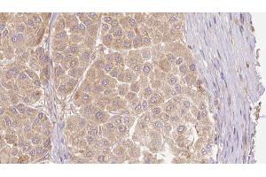 ABIN6273781 at 1/100 staining Human Melanoma tissue by IHC-P. (FGF19 antibody  (C-Term))