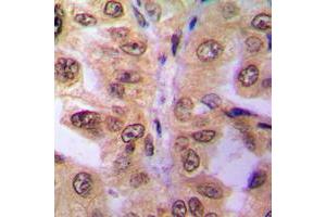 Immunohistochemical analysis of SIAH2 staining in human breast cancer formalin fixed paraffin embedded tissue section. (SIAH2 antibody  (C-Term))