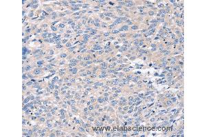 Immunohistochemistry of Human prostate cancer using ROR1 Polyclonal Antibody at dilution of 1:35
